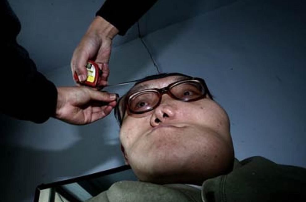 男孩得了怪病头部巨大,男孩得了怪病只有半个头