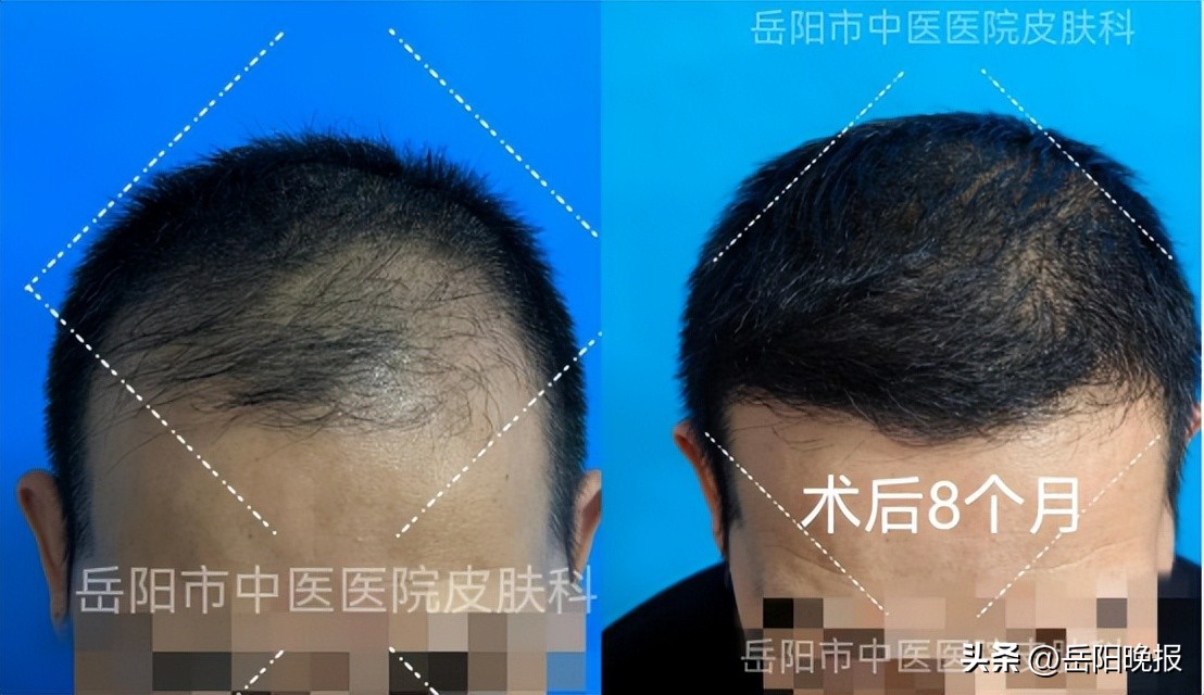 突如其来大学生脱发怎么办,脱发门诊大夫秃头怎么办