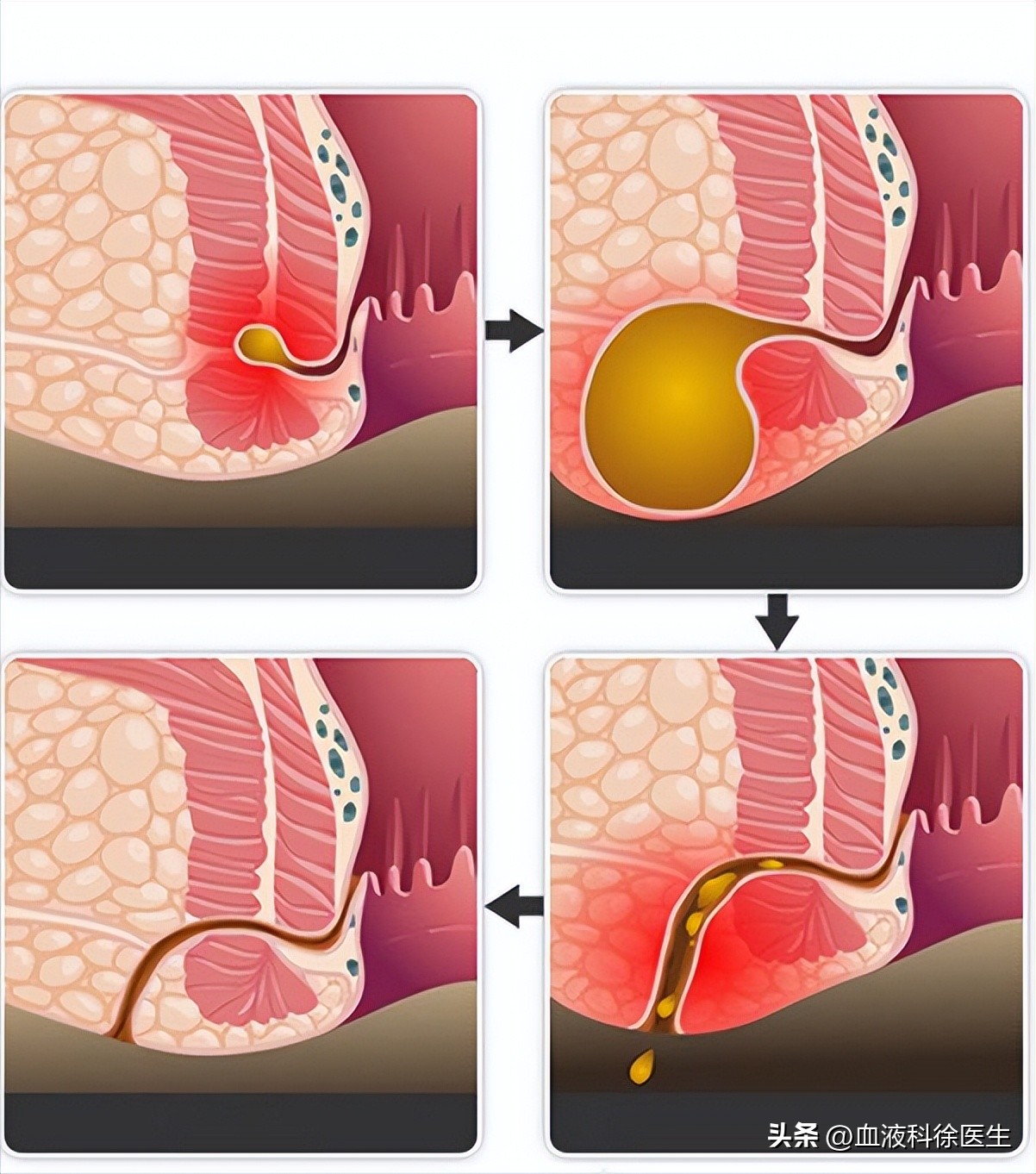 肛瘘手术真的有那么痛苦嘛,肛瘘手术在所有手术中的痛苦排名