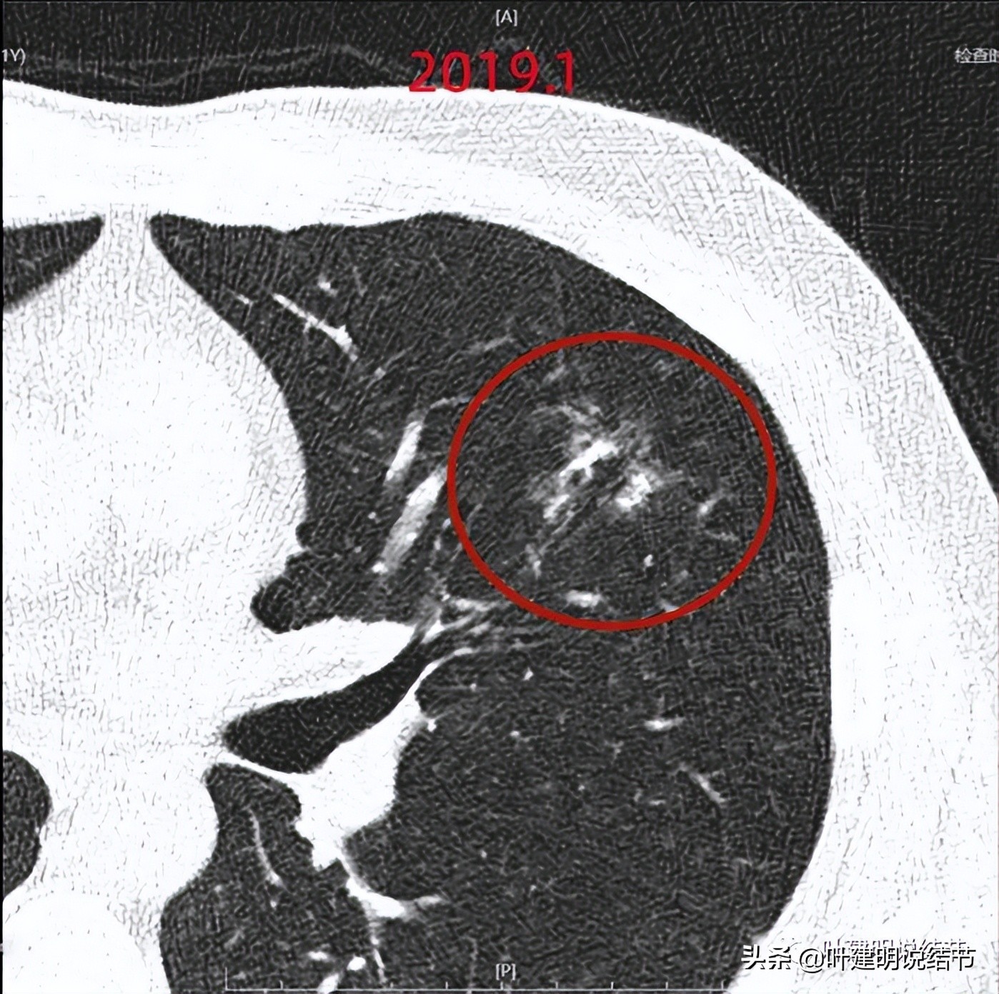 肺穿刺活检良性,肺穿刺活检容易形成气胸吗