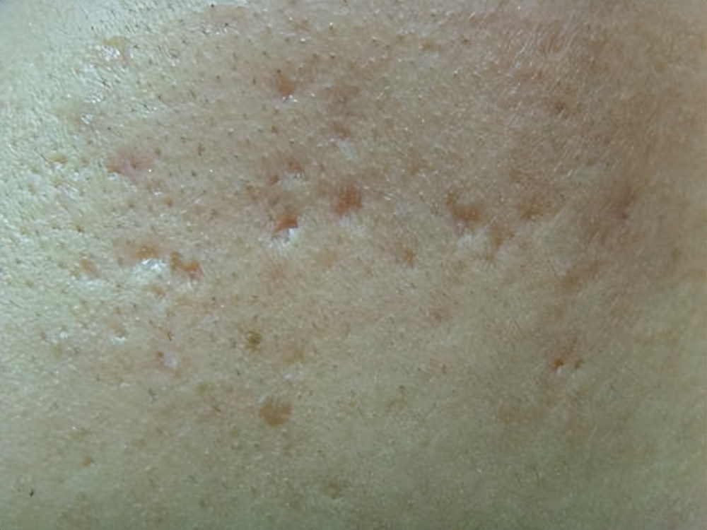 陈旧性的老疤痕该怎么有效修复？