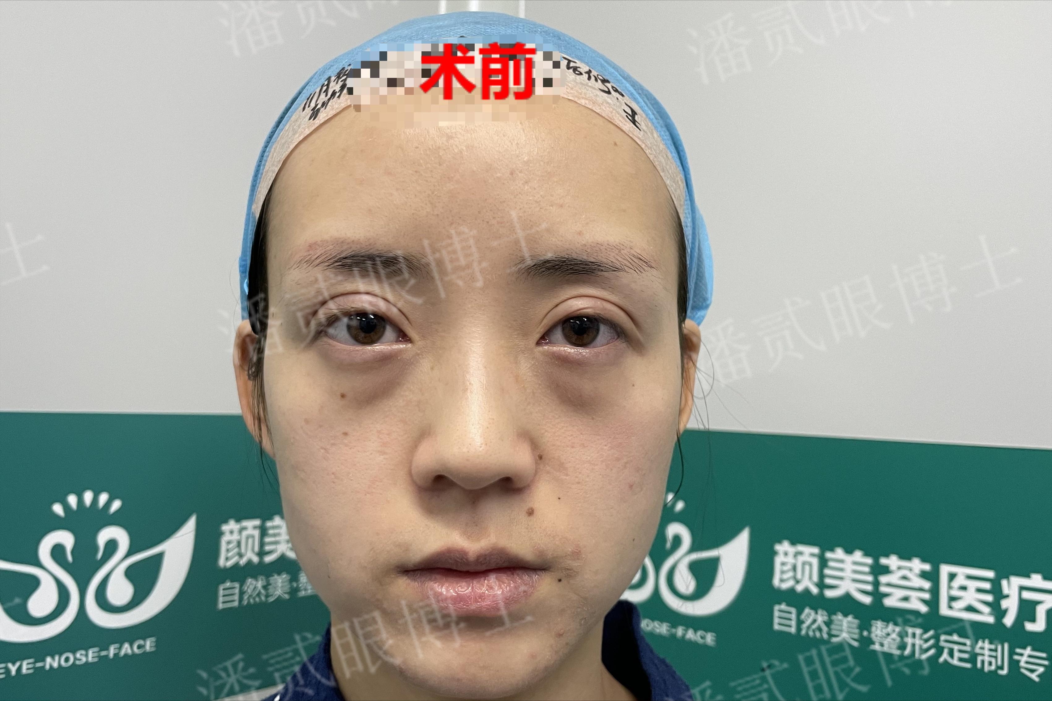 割双眼皮失败女的视频最新,割双眼皮失败女网红