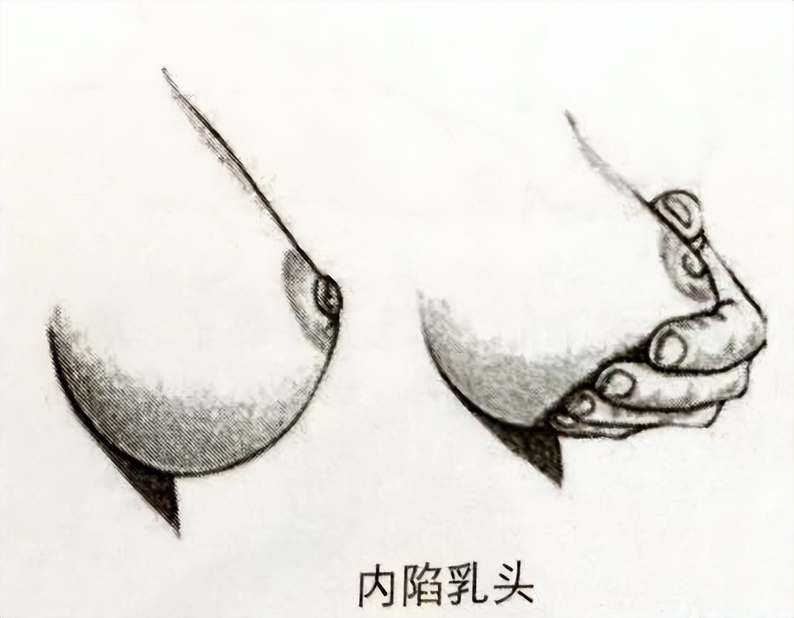 乳晕长了小疙瘩,正常吗?难不成是乳腺癌