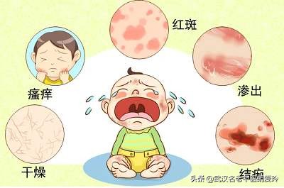 湿疹糜烂一直流黄水怎么办