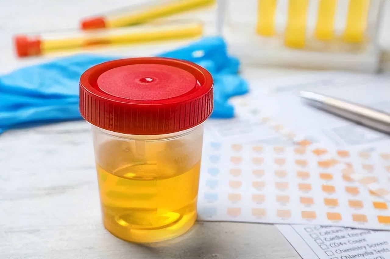 排尿黄异味大说明有什么问题,排尿出现三种现象可能暗示什么