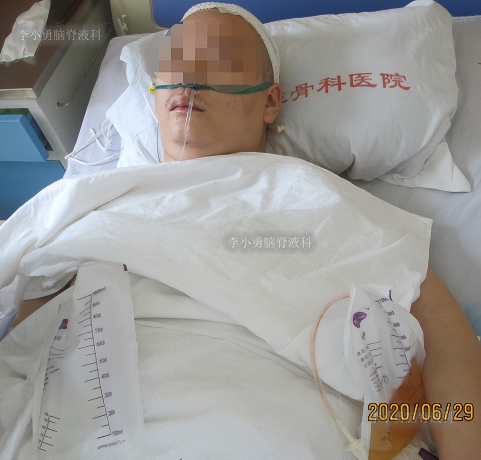 脑积水三脑室造瘘多久能恢复,脑囊虫手术后脑积水