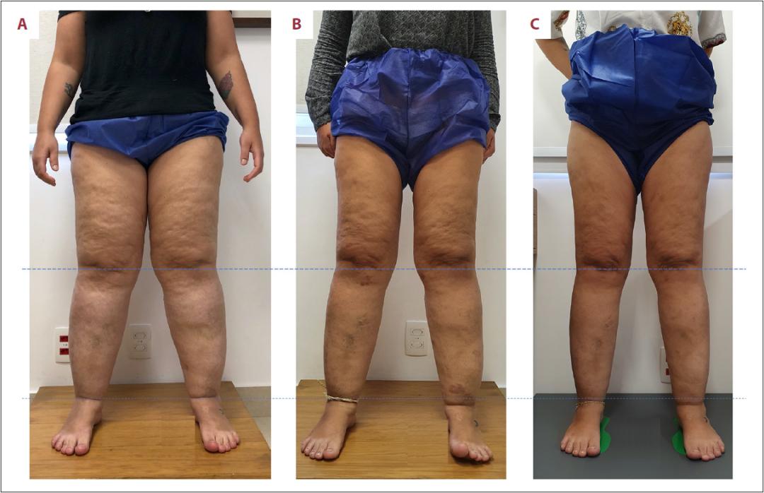 脂肪性水肿,脂肪型小腿水肿怎么消除