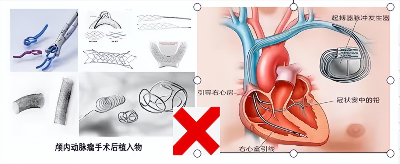 大肠癌科普知识(四十四)大肠癌必做检查之直肠MRI的必要性