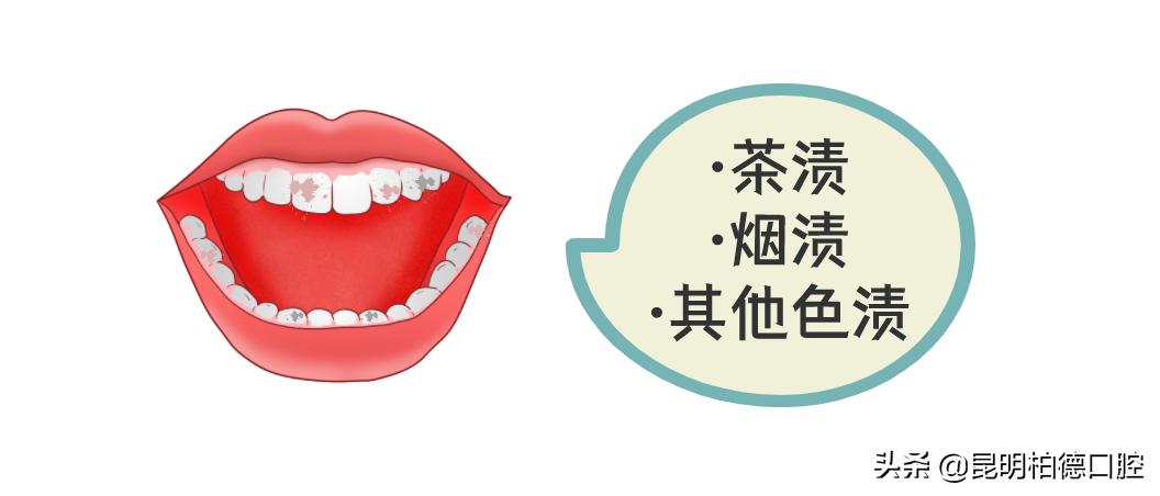 洗牙喷砂和龈下刮治的区别,洗牙套餐里喷砂是什么意思