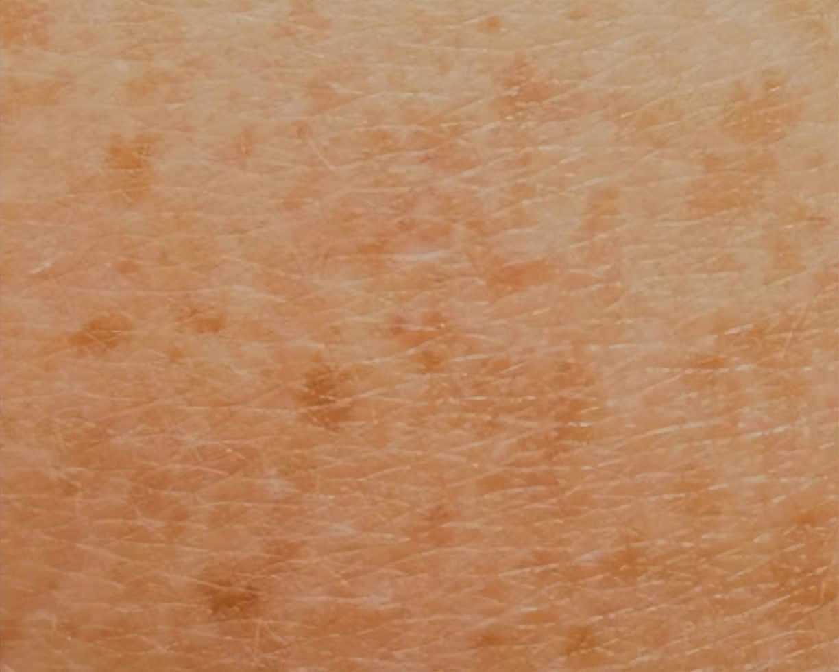 红霉素软膏真的能祛除老年斑吗,红霉素软膏去老年斑小妙招