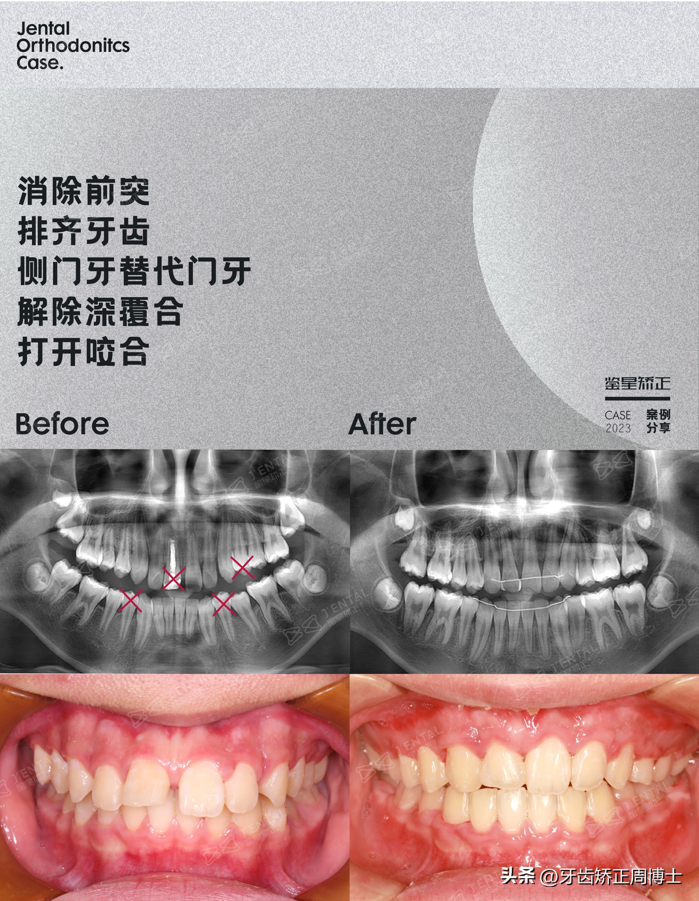 拔掉大牙做矫正好还是植牙好,拔掉4颗牙齿正畸收缝有几种方法