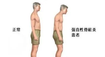 强直性脊柱炎中医可以治好吗,强直性脊柱炎稳定期中医辨证论治