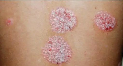 真菌清热除湿的口服中成药,细菌性皮肤病的常用药