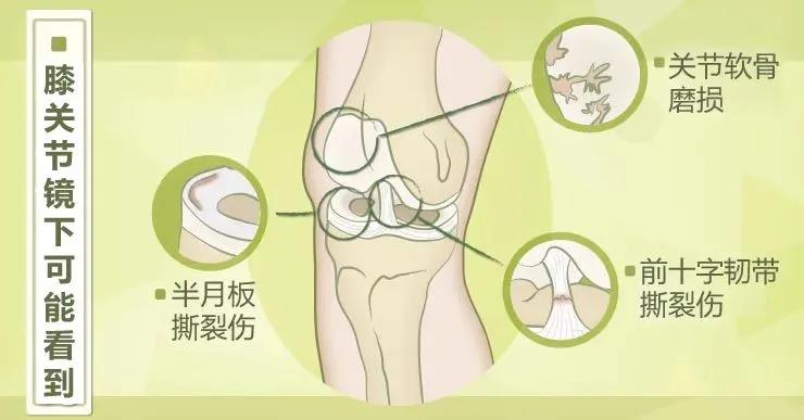 关节镜可以找到膝盖疼的原因吗,膝盖关节镜副作用