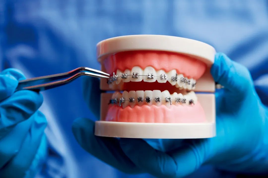 全国多少人做牙齿矫正,全国一年有多少人做牙齿正畸