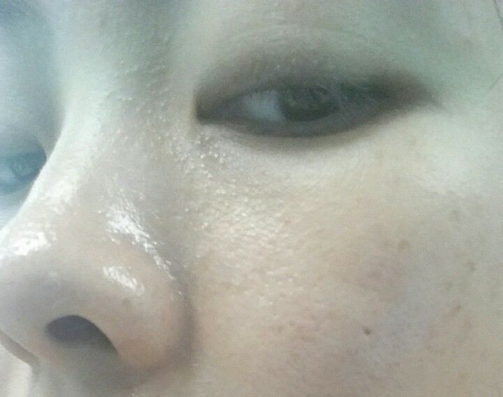 鼻头长黑粉刺怎么回事图片,鼻梁及两侧起了闭口粉刺