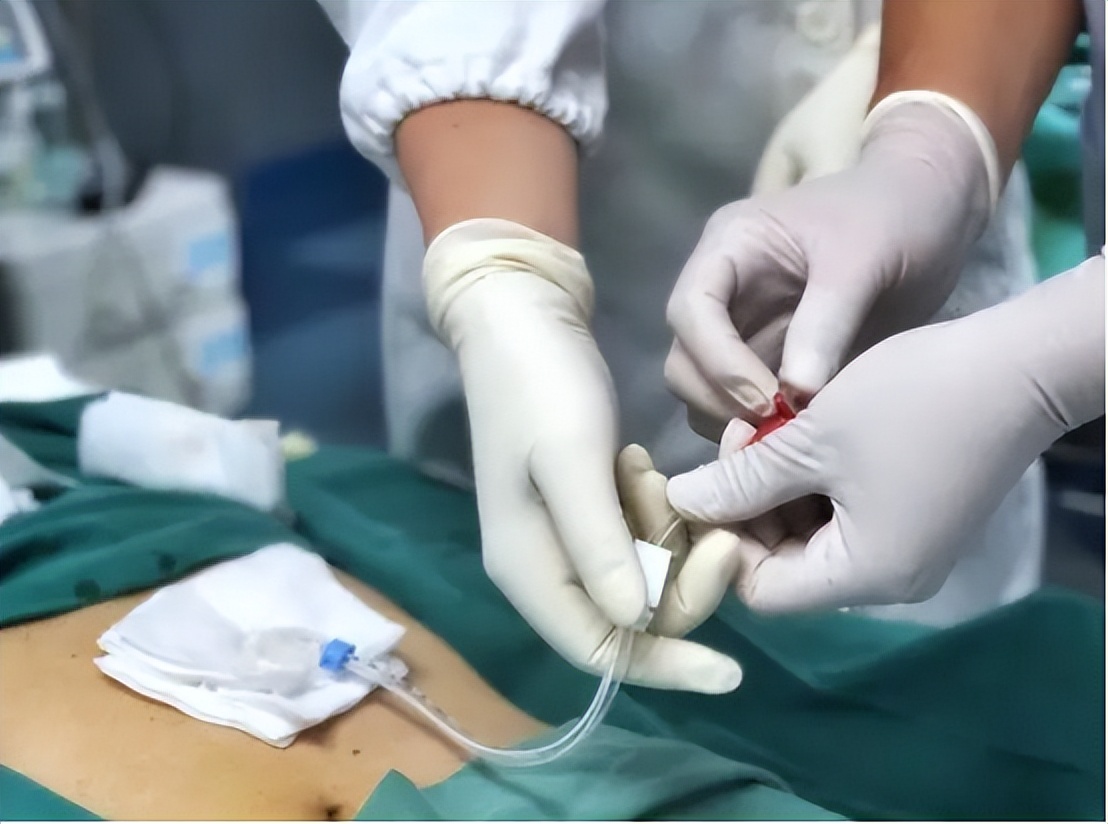 急性胆囊炎的主要治疗方法有哪些,急性胆囊炎最佳的治疗方案是什么