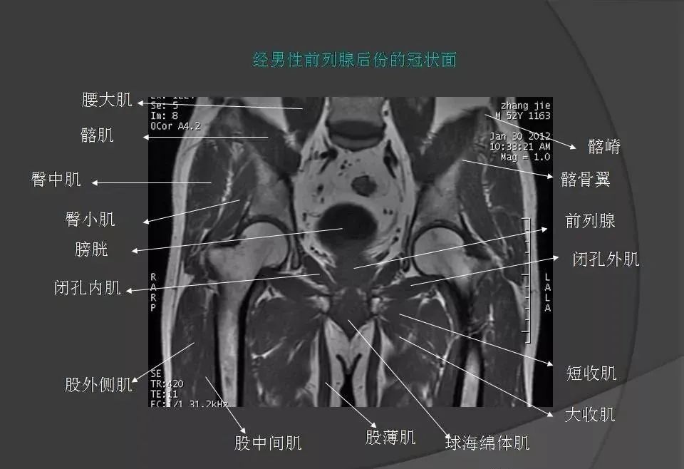 女性盆腔ct连续断层解剖图,盆腔mri影像病例分析