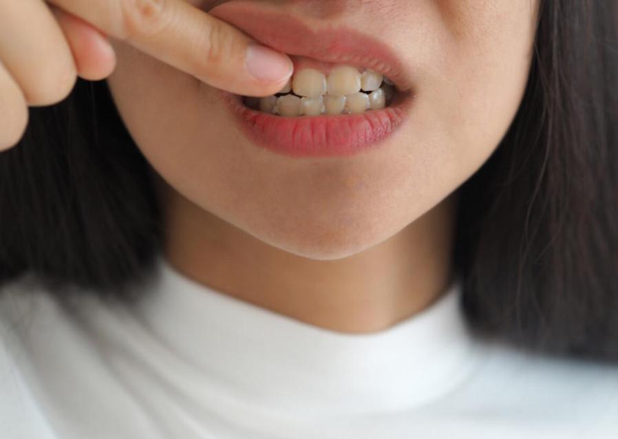 牙缝里的牙结石怎么自己去除,牙缝的牙结石怎么清理