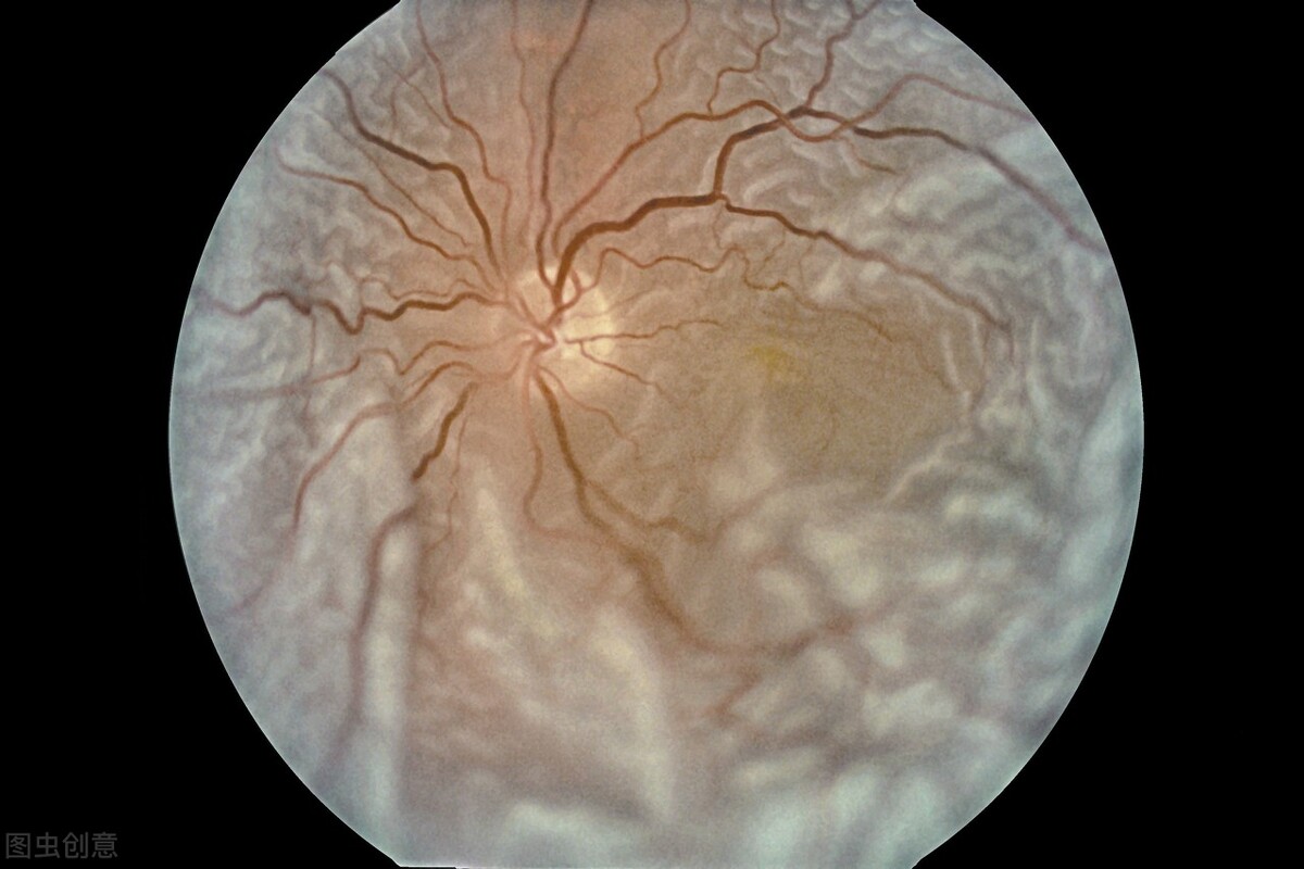 从中医的角度解说视网膜脱落,眼科手术不当会导致视网膜脱落吗