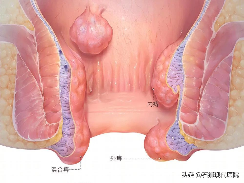 肛门处有分泌物如何自我判断？有哪些应急处理方法？