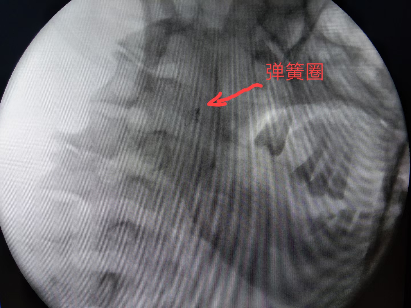 舌癌病例分享,舌癌吐血