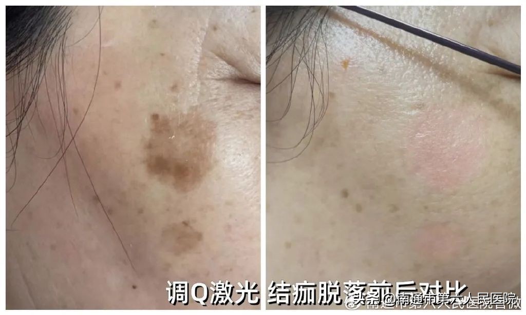 冰点脱毛除唇毛,冰点脱毛能根除体毛吗