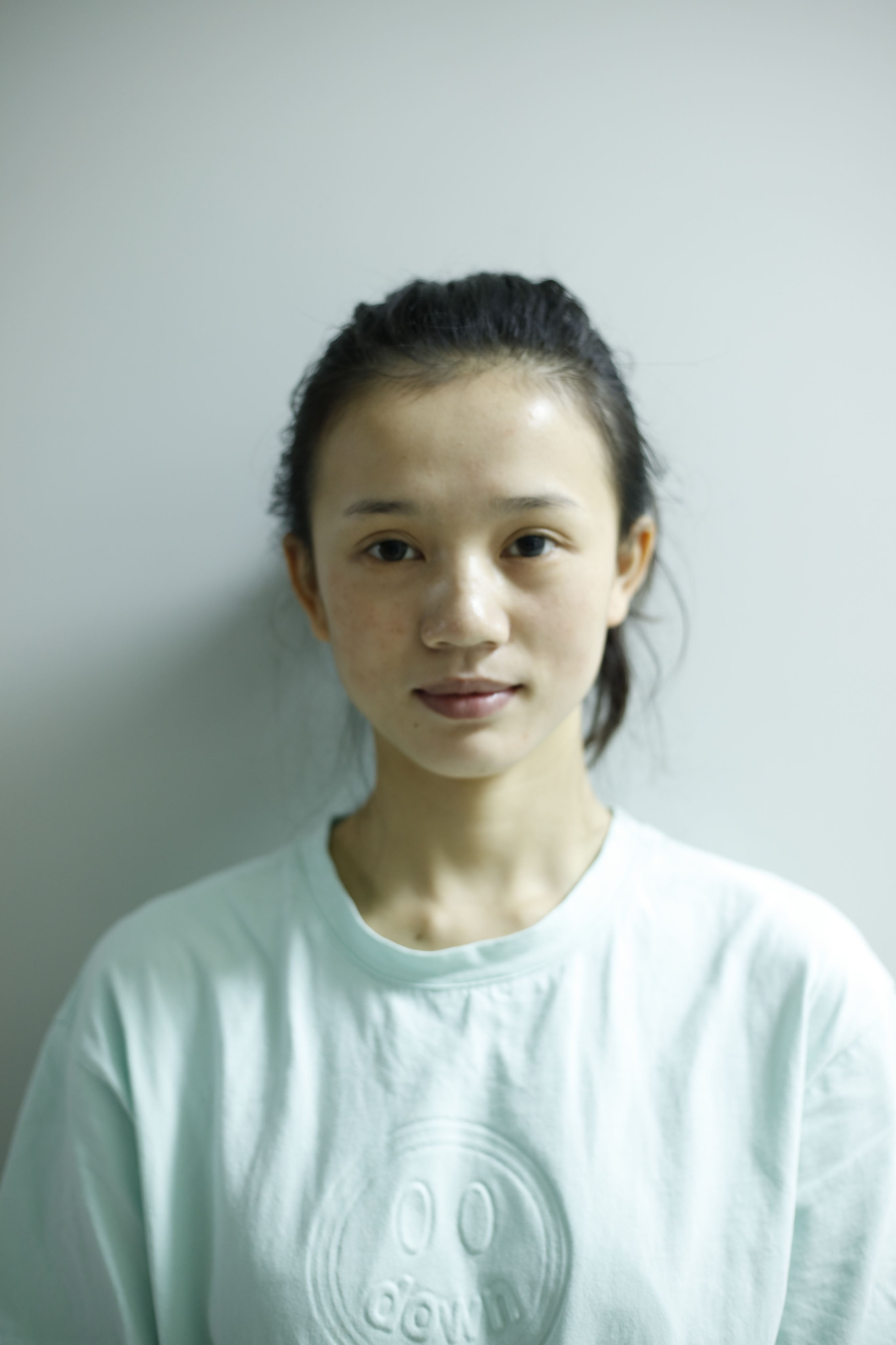 再漂亮的小姐姐也会被痘印困扰，治疗完后感叹激光治疗效果真不错