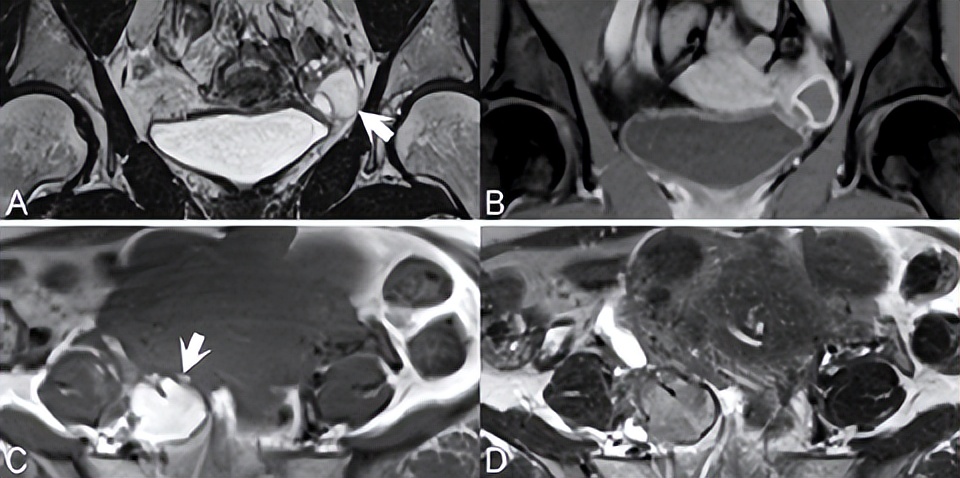 卵巢病变需要做什么检查,卵巢巧克力囊肿磁共振表现