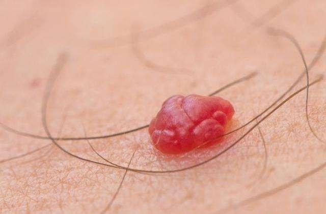 肝硬化代偿期手臂有小红点脂肪粒,肝硬化出现小红点可以自己消失吗