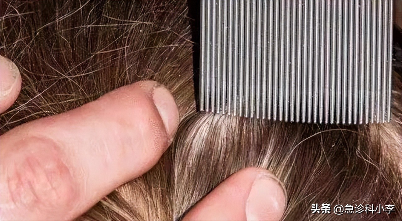 虱子和虱子有什么不同,虱子与人类共存千万年为何不见了