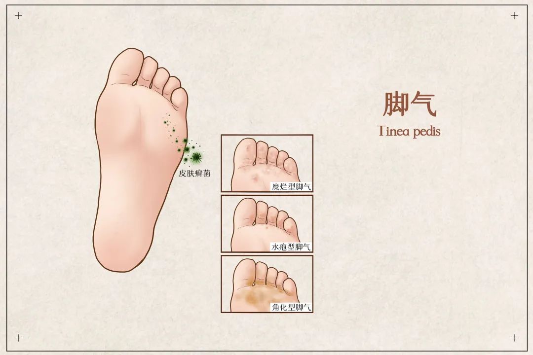 一到夏天就长脚气怎么治疗,一到夏季脚气就复发