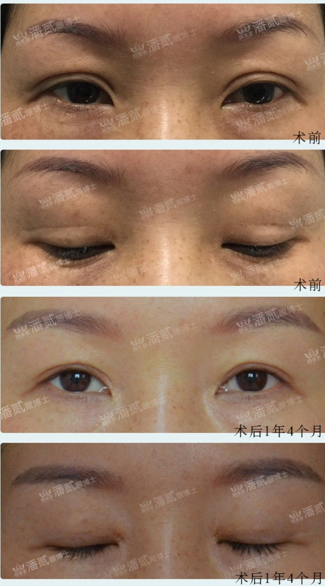 潘二博士双眼皮修复价格,潘贰眼博士修复技术真的好吗