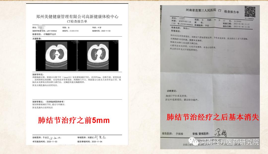 甲状腺结节乳腺增生经方案例,王付教授谈结节