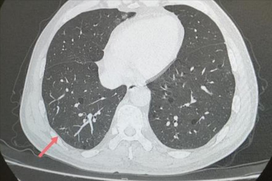 肺结节空泡征一年没变化,肺结节空泡一定恶性吗
