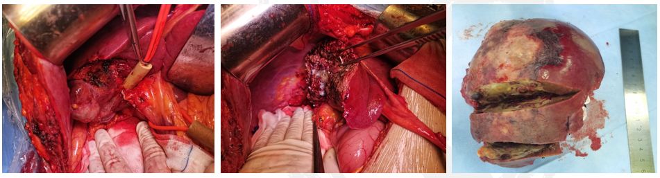 病例分享丨晚期肝癌治疗新策略，把不可能变为可能！