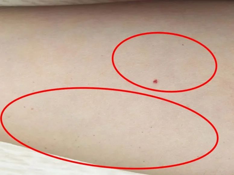 警惕身上出现的小黑痣,警惕皮肤黑痣