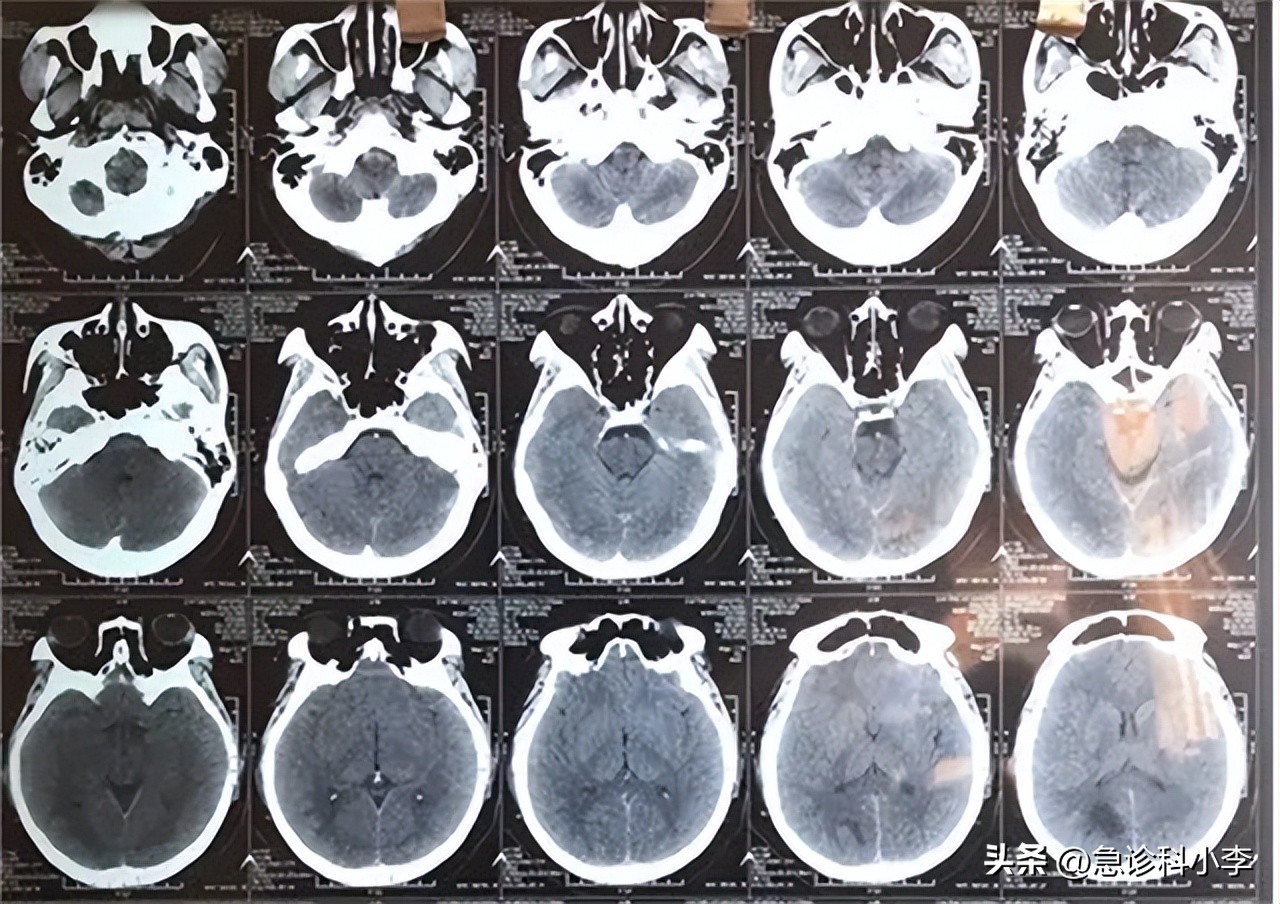 儿童得了脑胶质瘤最多活几年,脑胶质瘤患者的真实就医经历
