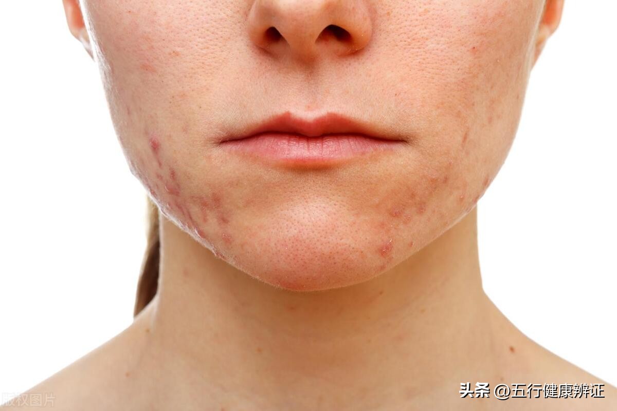 怎么消除湿热热毒,湿热喝复方金银花颗粒有用吗