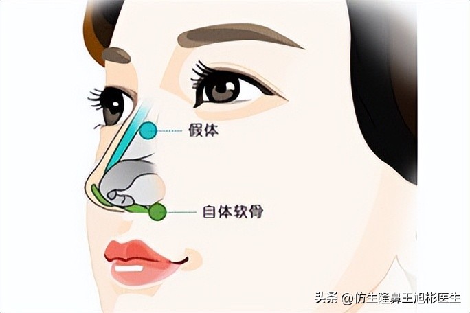 耳软骨隆鼻和肋软骨隆鼻图片对比,耳软骨隆鼻和假体耳软骨隆鼻