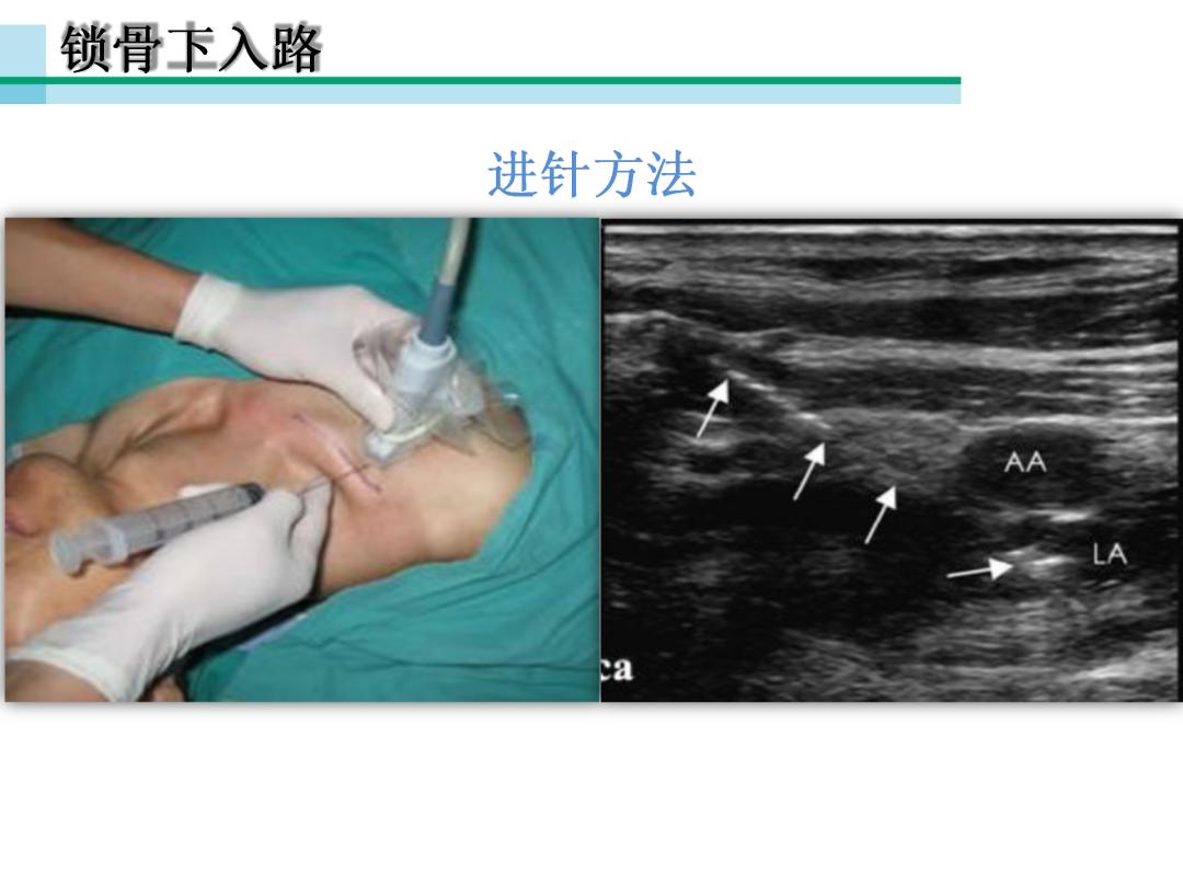 超声引导下臂丛神经阻滞,PPT课件