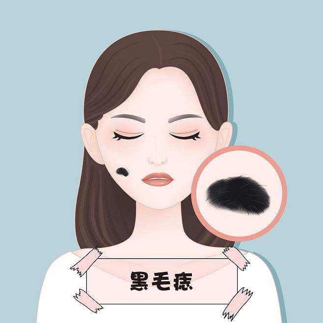 血管瘤胎记微创手术一般要多少钱,胎记与血管瘤的区别