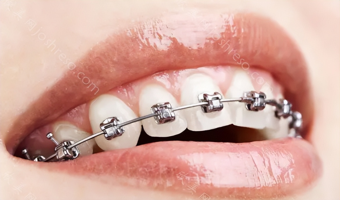 传统钢牙牙套佩戴过程,大牙戴牙套一般建议什么样的