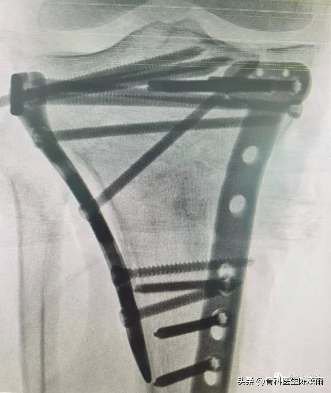 膝关节胫骨平台骨折,最近胫骨平台骨折视频