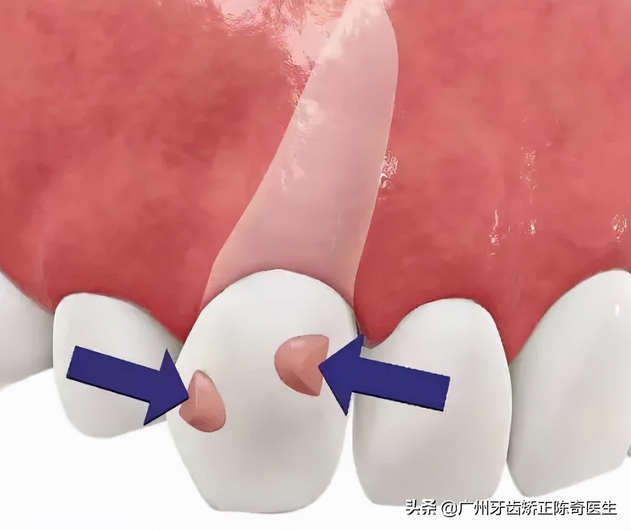 附着在牙齿上面硬硬的东西是什么,牙齿连接处有小疙瘩