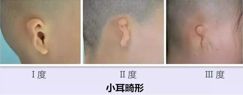 新生儿小耳畸形父母怎么调整心态,小耳畸形是遗传吗