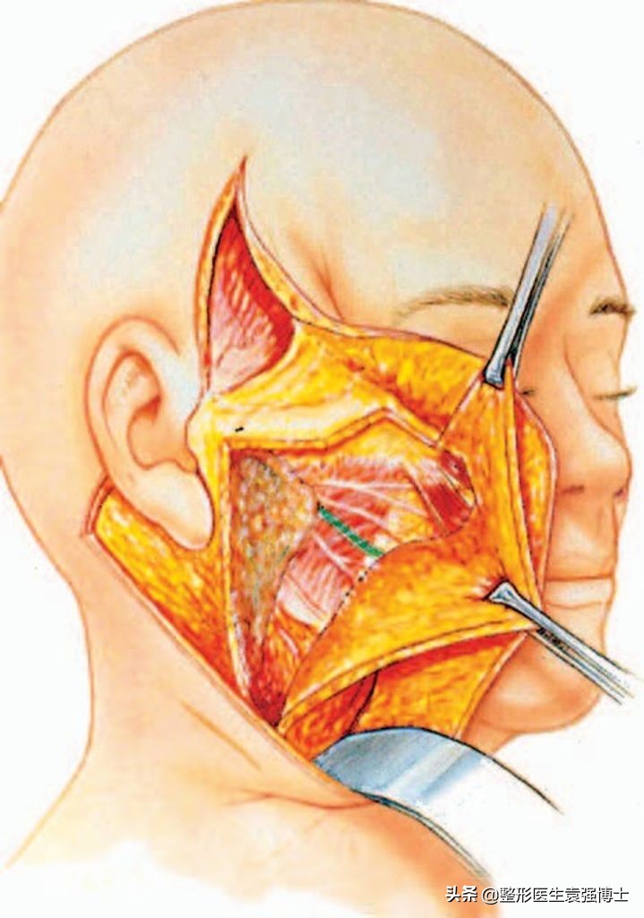 肚皮松弛拉皮手术有副作用吗,脸上做拉皮手术有无副作用