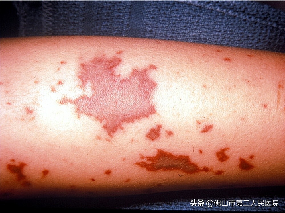 阳过之后皮疹怎么回事,阳了以后皮疹