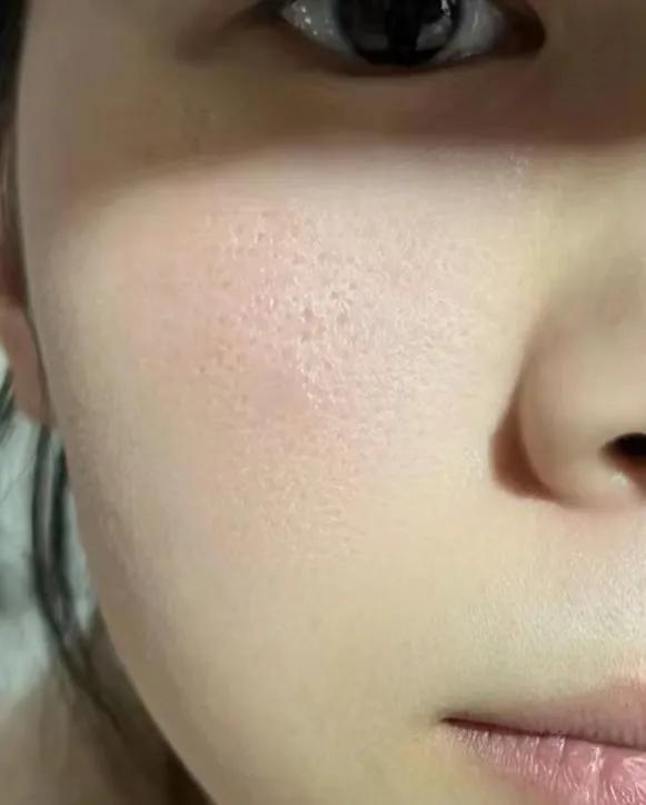 几款解决毛孔粗大的实用方法,毛孔粗大全搞定这些知识要牢记