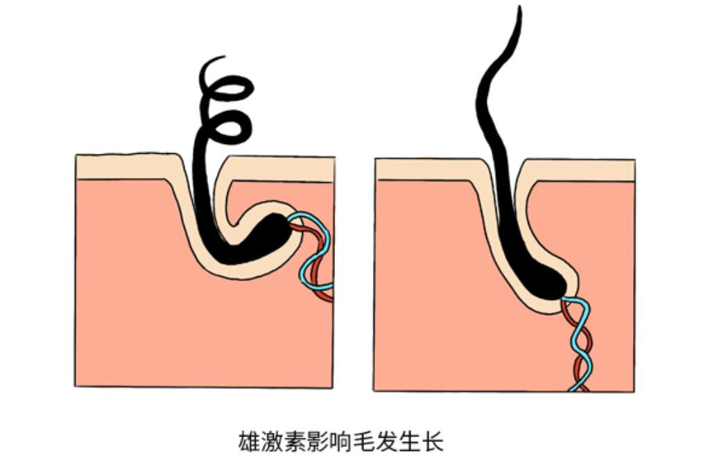 男性体内雄性激素越旺盛就越好吗？提醒：雄激素旺盛或会导致脱发